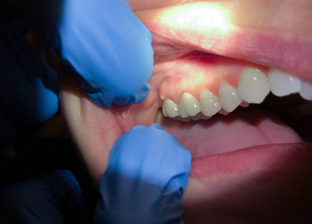 Best Emergency Tooth Extraction in Nevada City, CA